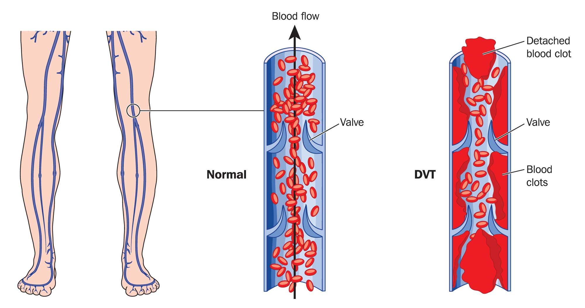 Patients with diabetes are at a 15% increased risk of developing another condition called Deep Vein Thrombosis (DVT)?