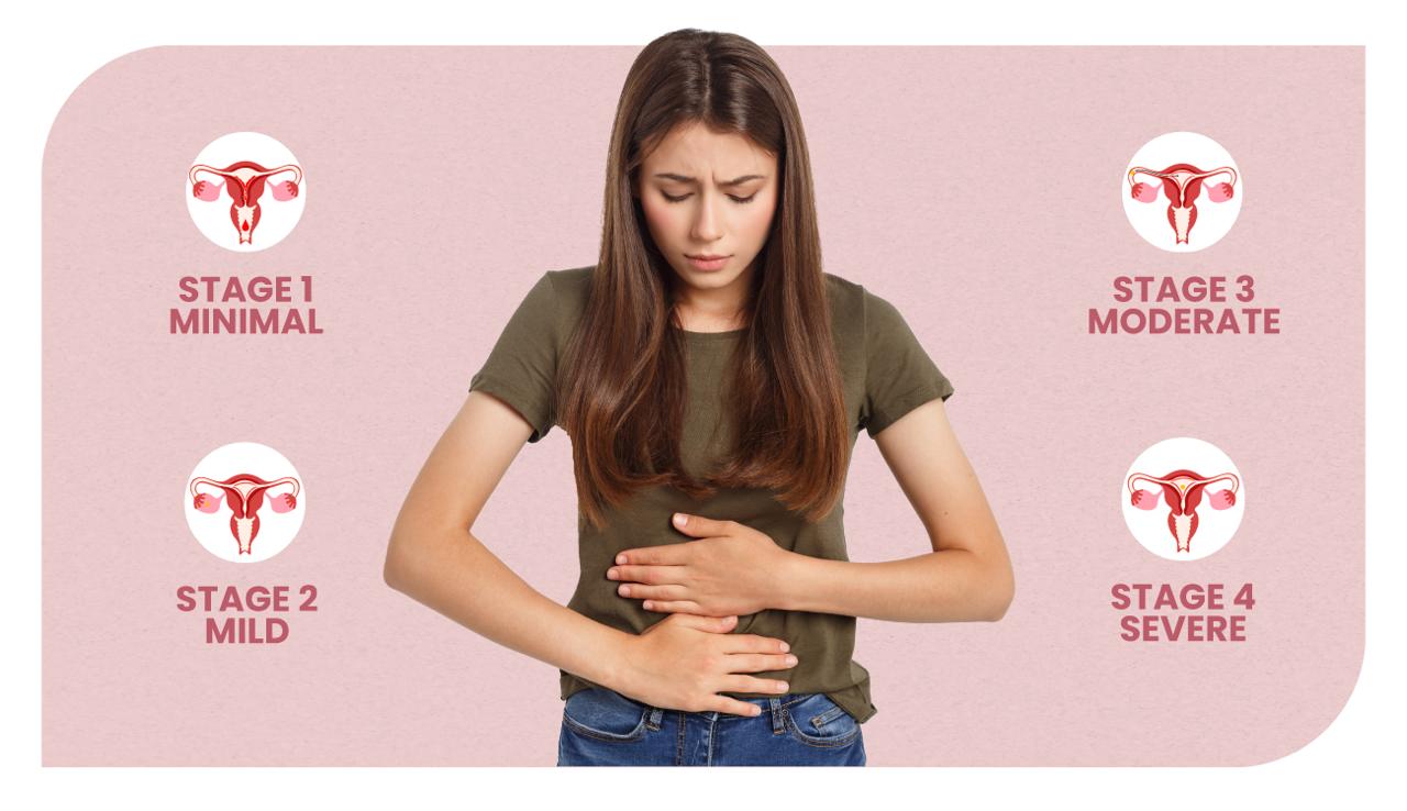 Endometriosis unlocked: Symptoms, Stages and Diagnosis